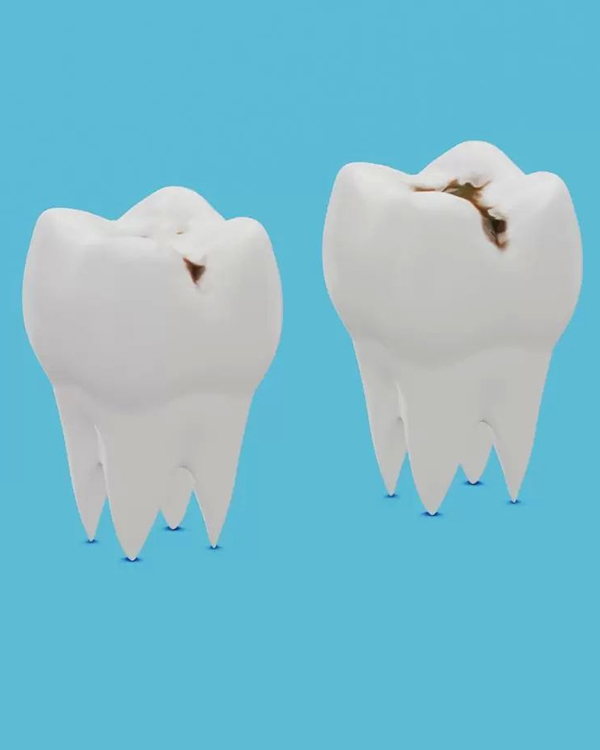 Dentista Carie