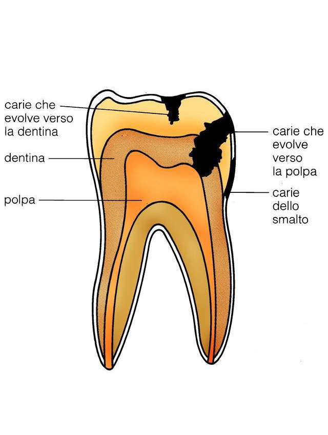 Dentista Carie