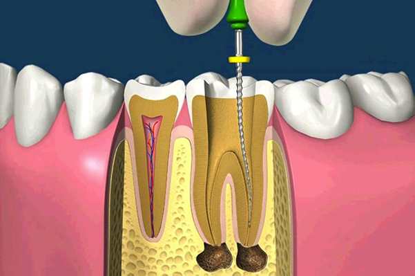 Endodonzia