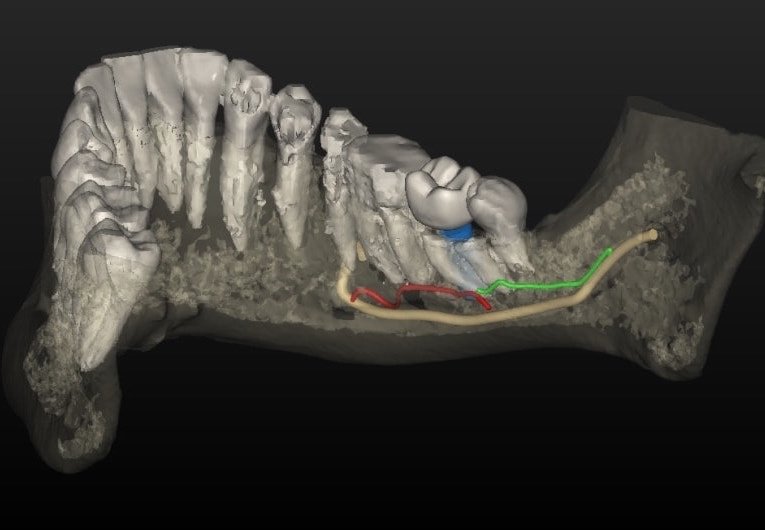 Implantologia computer guidata